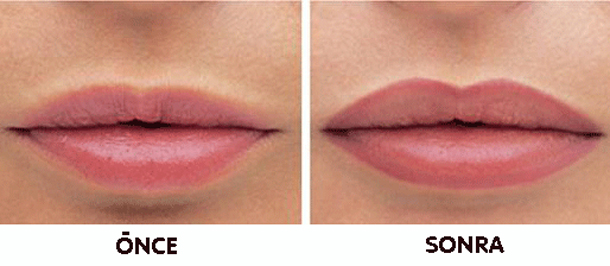 dudakları-büyük-göstermek